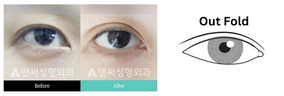 Non-incisional Double Eyelid Surgery  