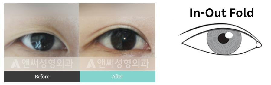 Non-incisional Double Eyelid Surgery  