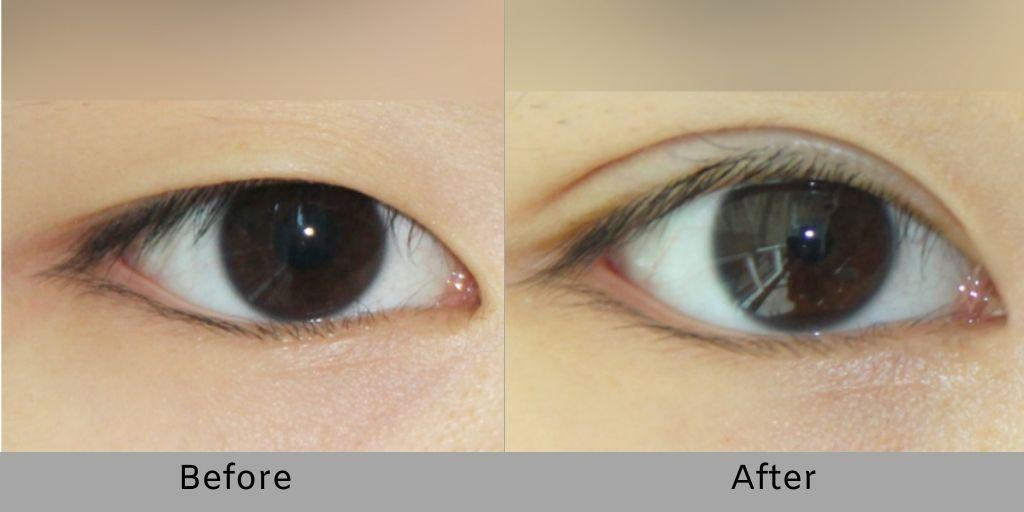 Non-incisional Double Eyelid Surgery
Non-incisional Double Eyelid Surgery