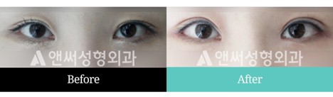 Revision Eye Surgery Revision Eye Surgery