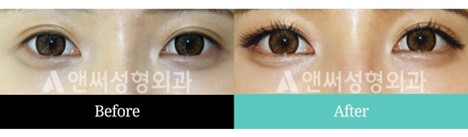 Revision Eye Surgery Revision Eye Surgery