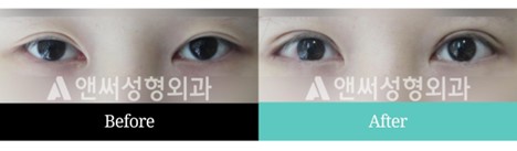 Revision Eye Surgery Revision Eye Surgery