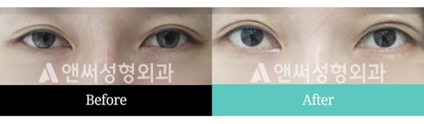 Revision Eye Surgery Revision Eye Surgery