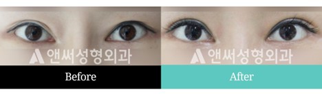Revision Eye Surgery Revision Eye Surgery