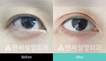 Revision Eye Surgery Revision Eye Surgery