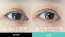 Revision Eye Surgery Revision Eye Surgery