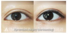 Revision Eye Surgery Revision Eye Surgery