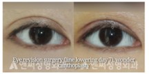 Revision Eye Surgery Revision Eye Surgery