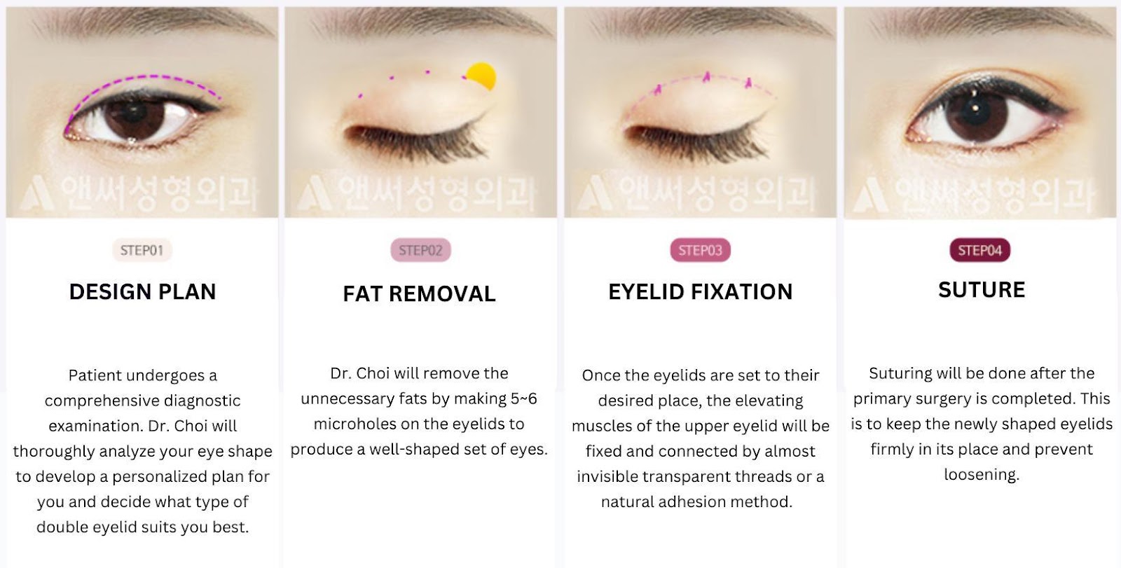 Non-incisional Double Eyelid Surgery
Non-incisional Double Eyelid Surgery