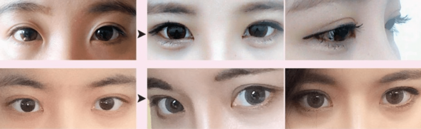 Non-incisional Double Eyelid Surgery
Non-incisional Double Eyelid Surgery
