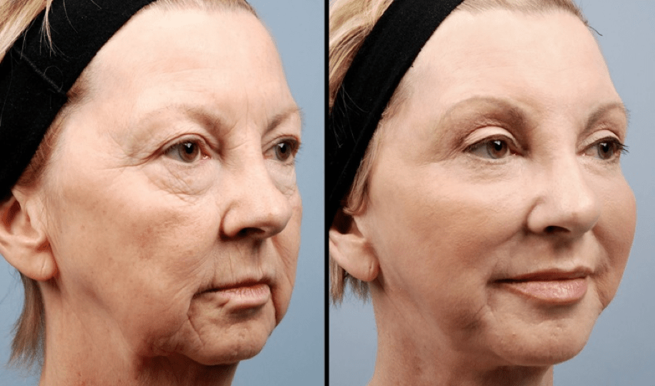 Fat Grafting Surgery In Korea, How Fat Grafting Works Fat Grafting Surgery In Korea, How Fat Grafting Works