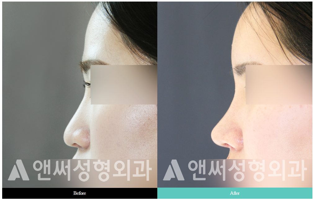 RHINOPLASTY RHINOPLASTY