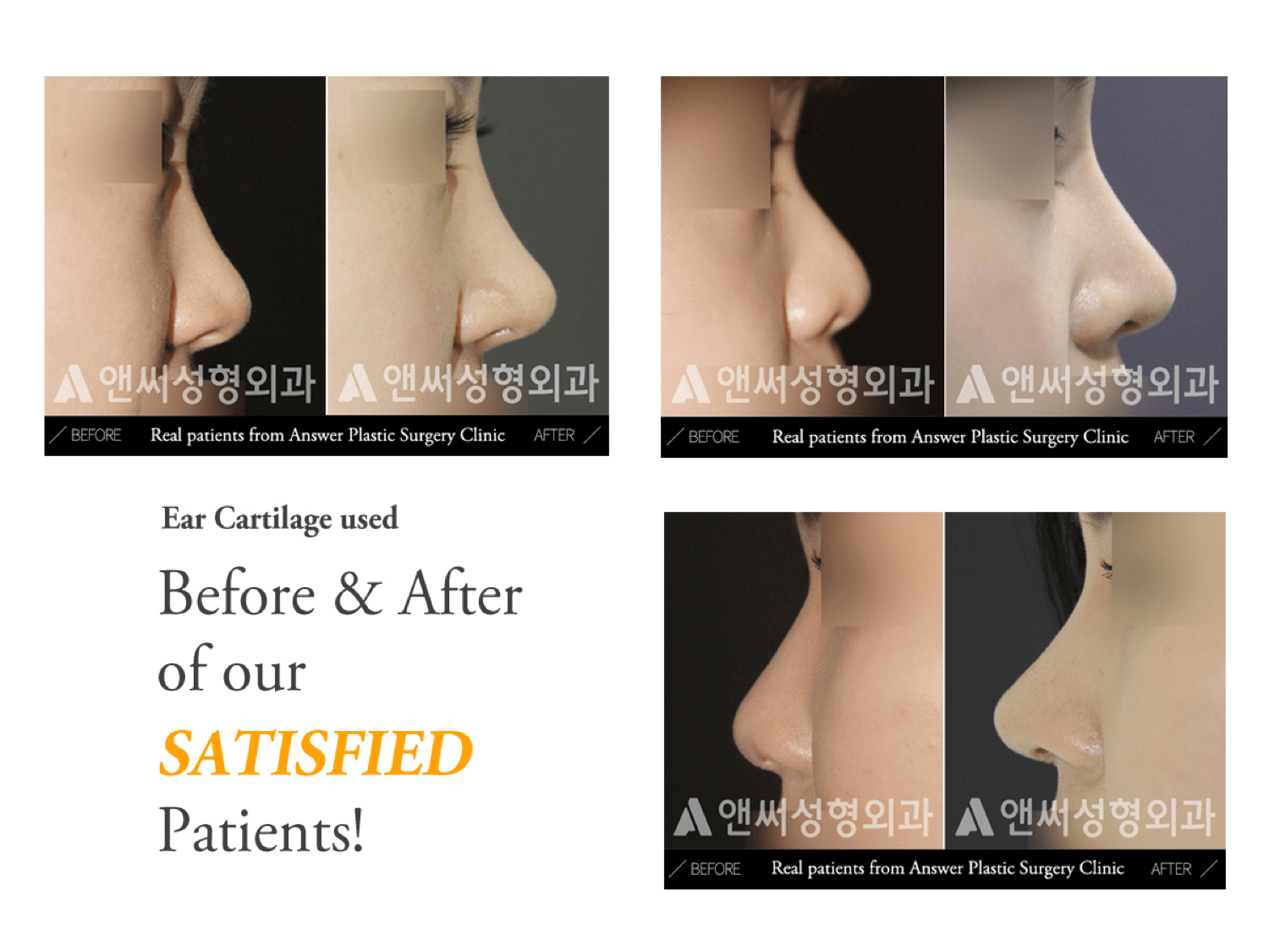 Rhinoplasty in Korea - Korean Nose Job Procedure Rhinoplasty in Korea - Korean Nose Job Procedure