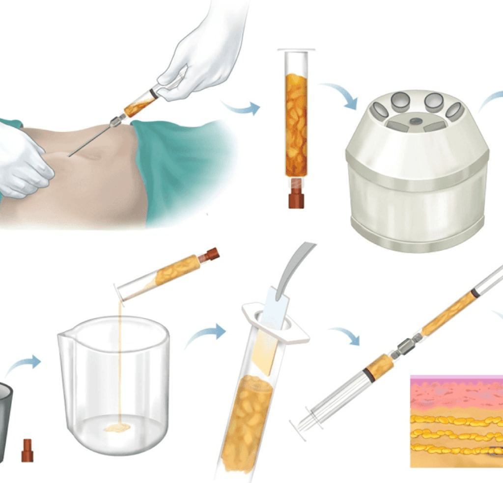 Fat Grafting Surgery In Korea, How Fat Grafting Works Fat Grafting Surgery In Korea, How Fat Grafting Works