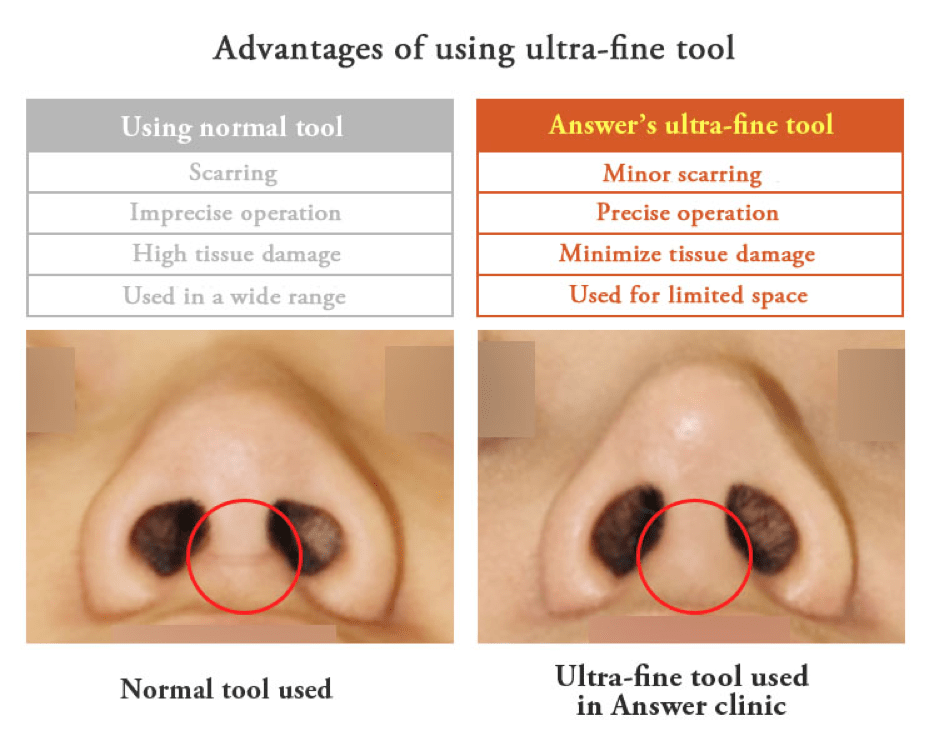 Rhinoplasty in Korea - Korean Nose Job Procedure Rhinoplasty in Korea - Korean Nose Job Procedure
