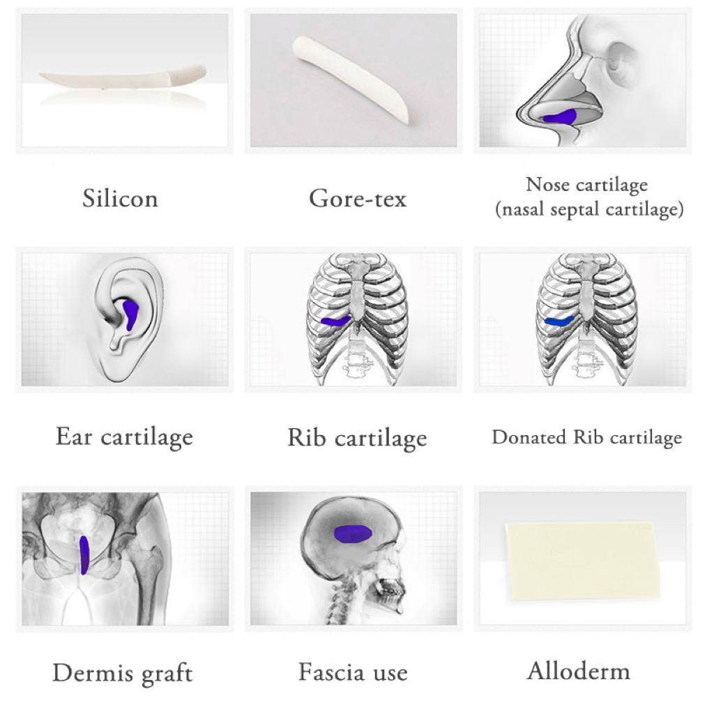 Rhinoplasty in Korea - Korean Nose Job Procedure Rhinoplasty in Korea - Korean Nose Job Procedure