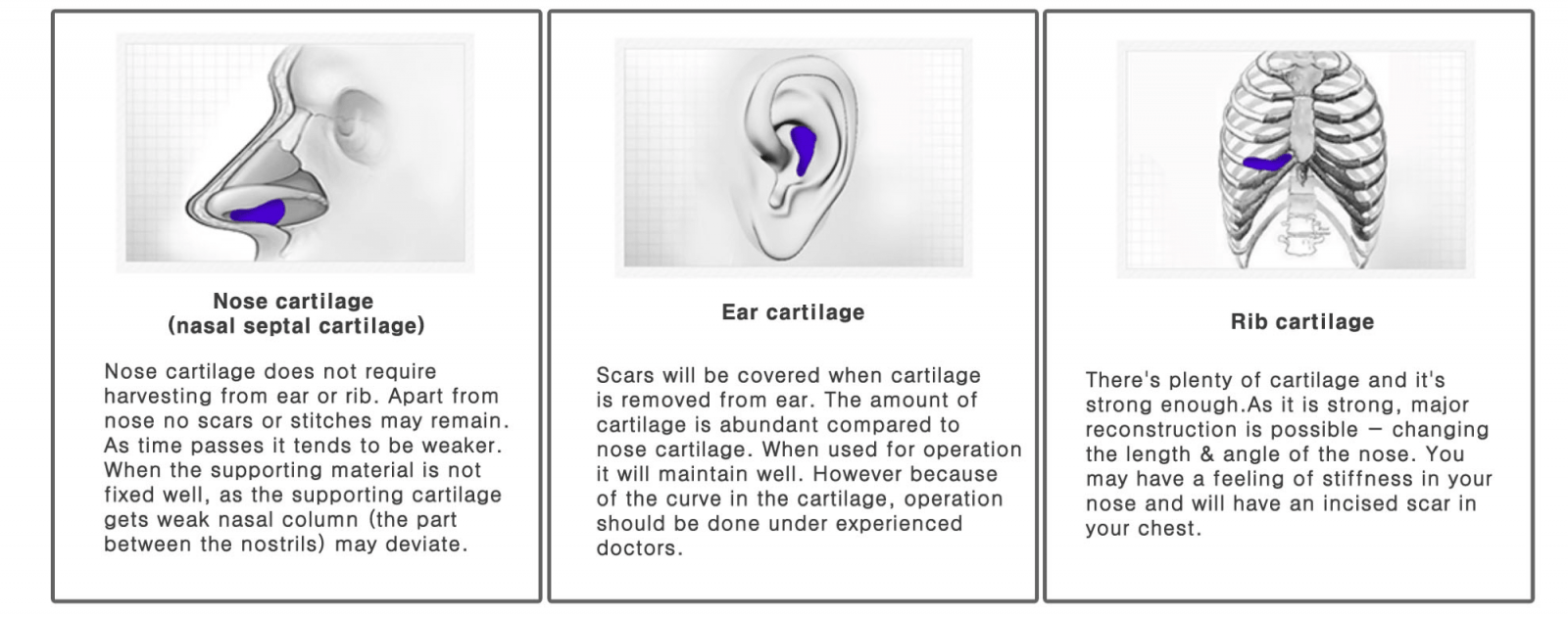 Rhinoplasty in Korea - Korean Nose Job Procedure Rhinoplasty in Korea - Korean Nose Job Procedure
