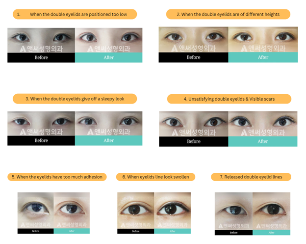 Revision Eye Surgery Revision Eye Surgery