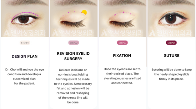 Revision Eye Surgery Revision Eye Surgery