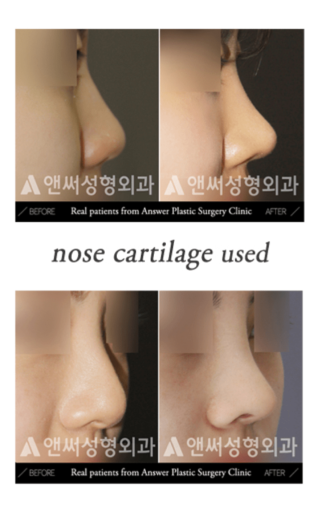 Rhinoplasty in Korea - Korean Nose Job Procedure Rhinoplasty in Korea - Korean Nose Job Procedure