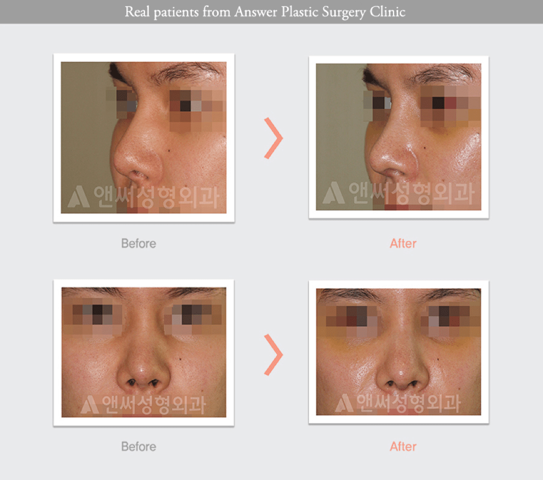 Rhinoplasty in Korea - Korean Nose Job Procedure Rhinoplasty in Korea - Korean Nose Job Procedure